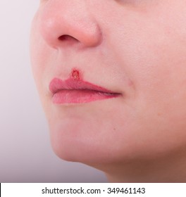 1,785 Lip blister Images, Stock Photos & Vectors | Shutterstock