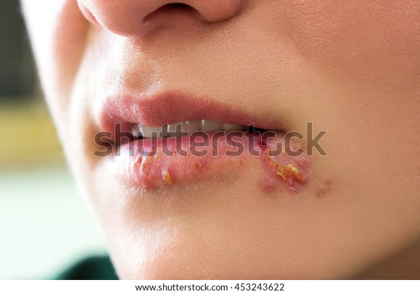Herpes kabarcıklar gösteren kız dudaklar
