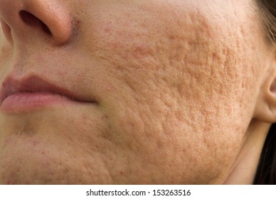 Girl With Problematic Skin And Acne Scars