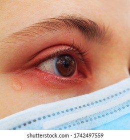 A girl in a protective medical mask. Close-up of a reddened, watery eye. Spring allergy concept.