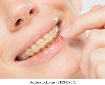 girl with sapphire braces happy girl with sapphire braces. medicine stomatology correction of teeth concept. - Shutterstock ID 2182459371