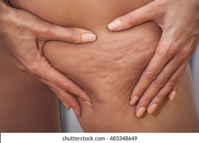 Girl shows holding and pushing the skin of the legs cellulite, orange peel. Treatment and disposal of excess weight, the deposition of subcutaneous fat tissue