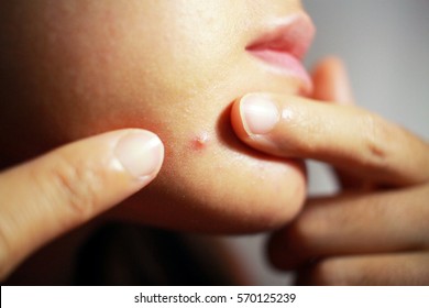 A Girl Is Squeezing An Acne On Her Chin By Her Index Fingers