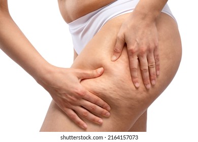 The girl stretches the skin on her leg, showing fat deposits and cellulite. The concept of weight loss and healthy lifestyle. - Shutterstock ID 2164157073