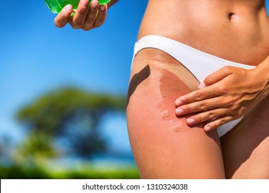 Girl With Sunburn Applying Aloe Vera Gel Soothing Lotion After Sun Cream. Tan Line On Bikini Hips Legs Woman Putting Sunscreen Sunblock Lotion Bottle. Skincare Red Skin Cancer Beach Summer Vacation.