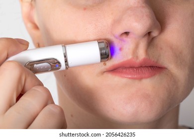 Girl Treats Inflamed Red Acne On The Skin Of The Face With A Laser Cosmetic Pen, Cosmetic Procedure. Dermatologist