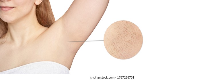 Girl underarm. White woman armpit. Before after epilation collage. Wax depilation result concept. Laser hair removal. sugaring spa procedure. Health care home routine. IPL treatment. Copyspace banner