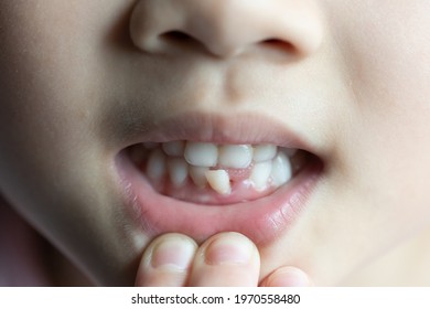 Incisor Images, Stock Photos & Vectors | Shutterstock