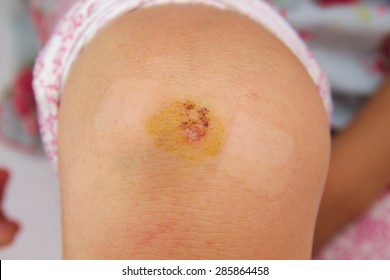 Girl With A Wounded Or Scraped Knee