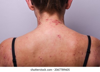 Girl's Back With Exacerbation Of Atopic Dermatitis. Skin Diseases. Scratching, Ulcers, Sores