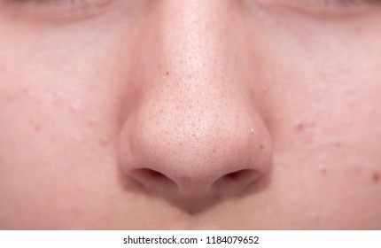 Nude chick bad acne gallery has Here Nude chick bad acne gallery opinion