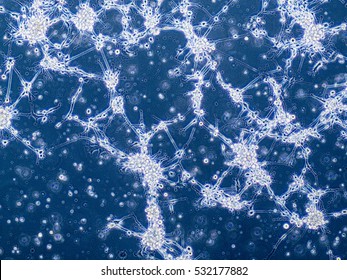 Glioblastoma Brain Cancer Cells Under Microscope