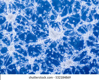 Glioblastoma Brain Cancer Cells Under Microscope