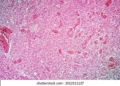 glioma tumor of the brain