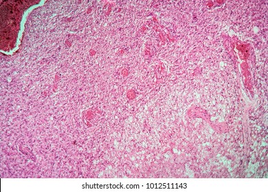 Glioma Tumor Of The Brain