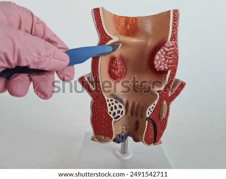 Gloved Hand Using a Scalpel to Point to a Rectal Model Showing Polyps