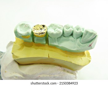 A Gold Crown In Dental Clinic