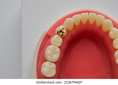 Gold Inlay Setting In Dentiform