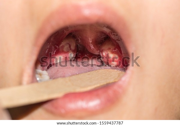 Gonorrhoea Tonsillitis Large Tonsils Inflamed Purulent Stock Photo ...