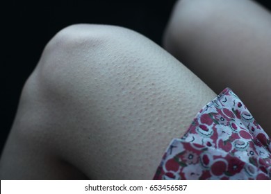 Goosebumps On A Woman Leg