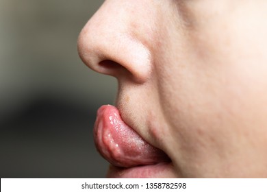 Gorlin Sign Is The Ability To Touch The Tip Of The Nose With The Tongue. Approximately 10% Of The General Population Can Perform This Act, Whereas 50% Of People With Ehlers-Danlos Syndrome Can.