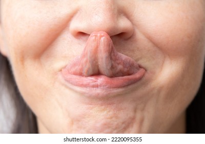 The Gorlin Sign Is A Medical Term That Indicates The Ability To Touch The Tip Of The Nose With The Tongue. Might Be The Sign Of Ehlers–Danlos Syndrome.