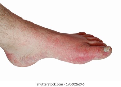Gout in foot. Male foot with swollen red big toe due to gout.