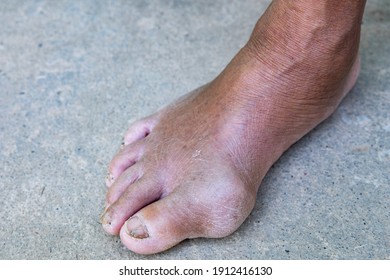 Gout Inflammation On Big Toe Joint And Fungal Nail Infection