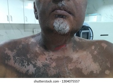 Grade Three Skin Reaction Due To Radiation Therapy Treatment Treated On External Beam Radiation Therapy On Cobalt Unit. The Patient Received Radiation Therapy For Five Week. Hyperpigmentation Is Shown