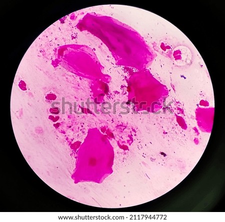 Gram positive cocci in cluster of Staphylococcus spp. under 1000X microscope.