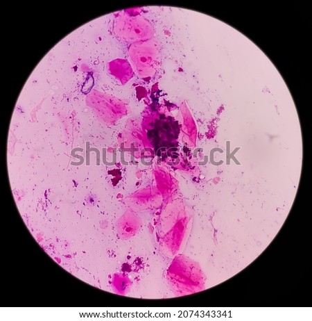 Gram stain: Gram positive cocci, Gram positive diplococci bacteria, candida present, squamous epithelium in sputum sample.