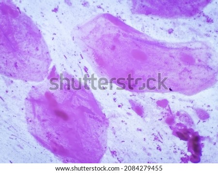 Gram stain: Gram positive cocci, Gram positive diplococci bacteria, candida present, squamous epithelium in sputum sample.