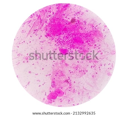 Gram stain: Gram positive cocci, Gram positive diplococci bacteria and squamous epithelium under microscopy.