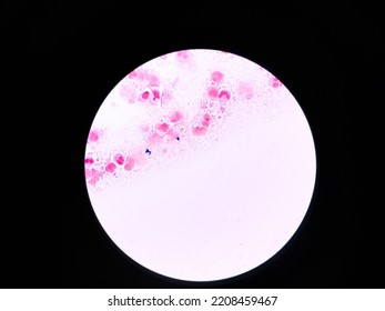 Gram Stain Showing Gram Positive Cocci Bacteria