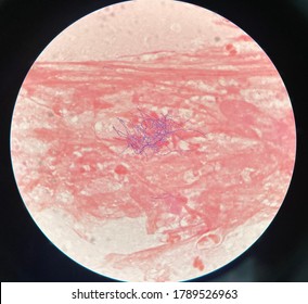 Gram Stain From Sputum , Nocardia Spp.