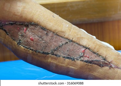 Granulation Tissue On Skin Graft Wound.