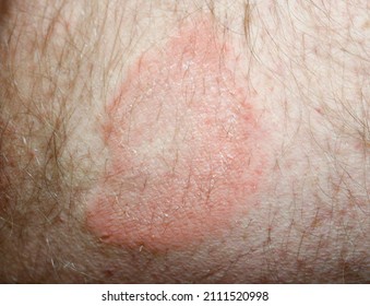 Granuloma Anulare, Skin Change On The Inner Thigh