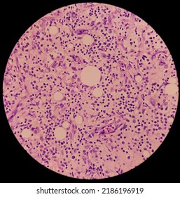 Granulomatous Inflammation With Tuberculosis. Microscopic Show Fibrofatty Tissue, Acute And Chronic Inflammatory Cells And Stellate Granuloma. Axillary Abscess Histology.