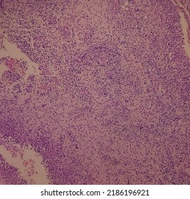 Granulomatous Inflammation With Tuberculosis. Microscopic Show Fibrofatty Tissue, Acute And Chronic Inflammatory Cells And Stellate Granuloma. Axillary Abscess Histology.