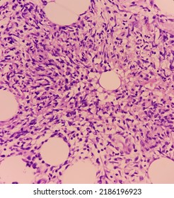 Granulomatous Inflammation With Tuberculosis. Microscopic Show Fibrofatty Tissue, Acute And Chronic Inflammatory Cells And Stellate Granuloma. Axillary Abscess Histology.