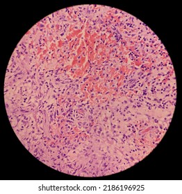 Granulomatous Inflammation With Tuberculosis. Microscopic Show Fibrofatty Tissue, Acute And Chronic Inflammatory Cells And Stellate Granuloma. Axillary Abscess Histology.