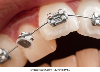 Gray broken braces or wire breaks missing - Shutterstock ID 2199988981