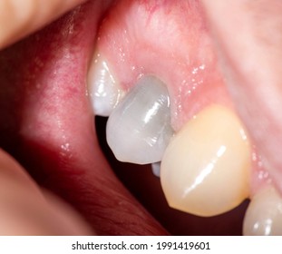 Gray darkened tooth after nerve removal and pulpitis disease. Lack of tooth nutrition, restoration and restoration of a dead tooth in modern dentistry, healthcare - Shutterstock ID 1991419601
