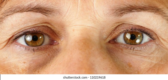 Great Detail Macro Of A Very Tired Or Sick Middle Age Woman, With Wrinkles, Sun Damage, Veins In The Puffy Eyes And Dark Circles Under The Eyes All Showing.