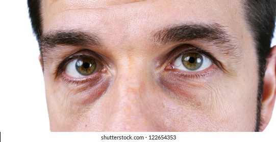 Great Detail Macro Of A Very Tired Or Sick Middle Aged Man, With Wrinkles, Sun Damage, Veins And Dark Circles Under The Eyes Showing, No Retouching, Natural Or Candid.