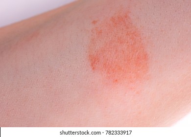 The Great Red Spot On The Skin Closeup