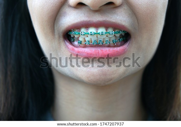 green colored braces