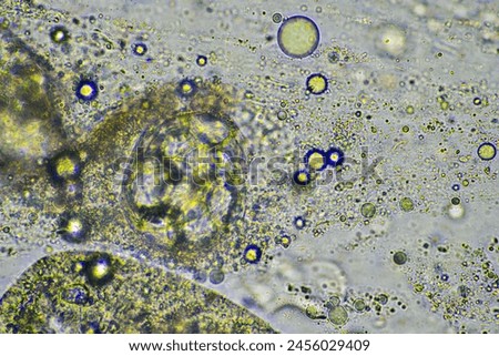 green mucus and coughing up phlegm under the microscope looking at influenza cells and cold snot from a human who is sick in australia