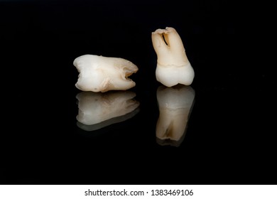 Caries Tooth Eruption Large Hole On Stock Photo (Edit Now) 1493628980