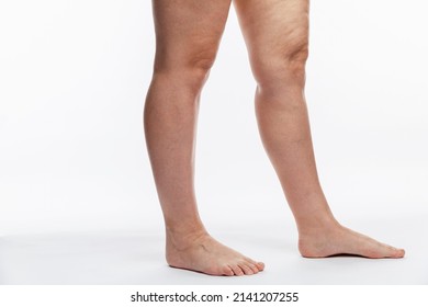 3,316 Cellulitis leg Images, Stock Photos & Vectors | Shutterstock